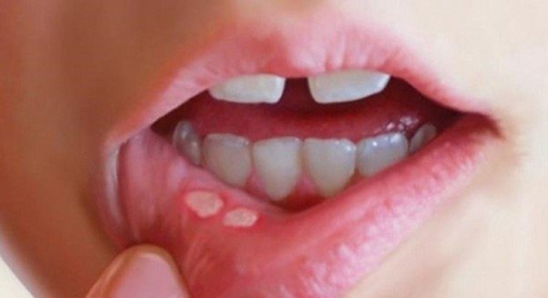 Aptor miệng có thể gồm 1 hoặc nhiều vết loét hình tròn hoặc bầu dục, kích thước to nhỏ khác nhau